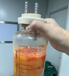涟源水动力吸脂手术要做多久？